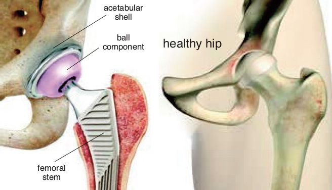 Muskegon Surgery Center - Total Hip